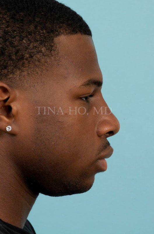 Rhinoplasty