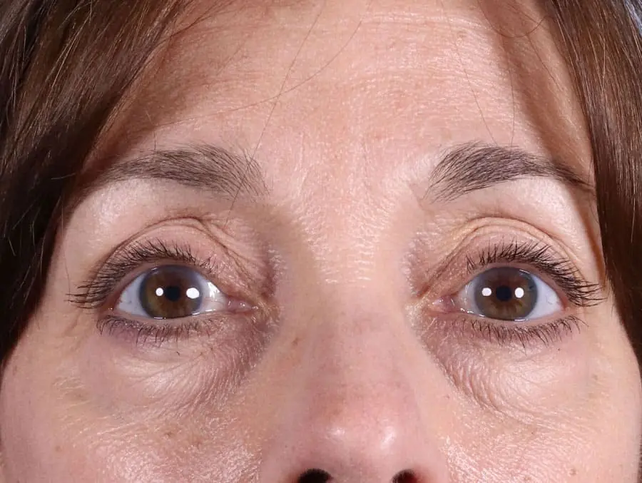 Close-up of a person's eyes before eye rejuvenation treatment