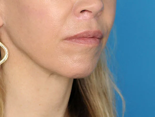 Female patient's lateral profile before chin augmentation procedure