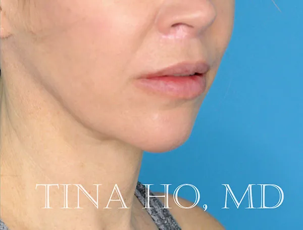Female patient's lateral profile after chin augmentation procedure