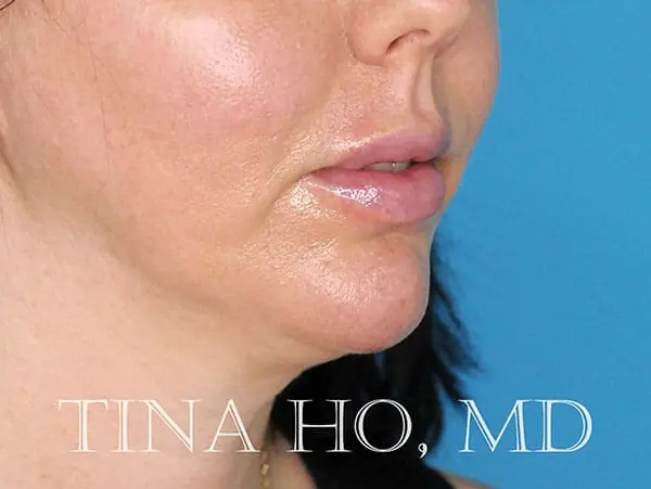 Female patient's lateral profile after successful chin augmentation procedure