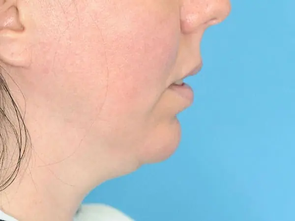 Female patient's lateral profile before chin augmentation procedure