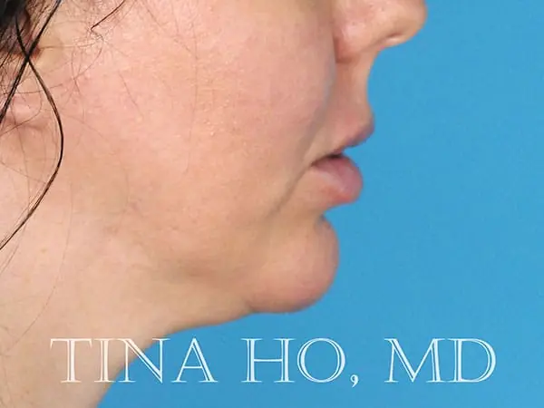 Female patient's lateral profile after successful chin augmentation procedure