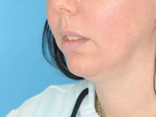 Patient's face showing results before a Philadelphia cheek augmentation and chin augmentation procedure, and dermal filler treatment