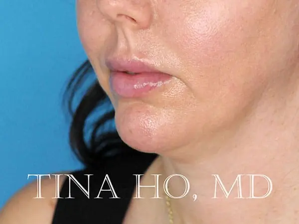 Female patient's lateral profile after successful chin augmentation procedure