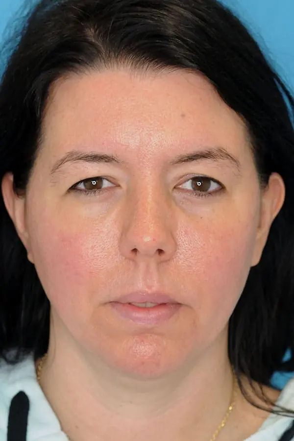 Patient's face showing results before a Philadelphia cheek augmentation and chin augmentation procedure, and dermal filler treatment.