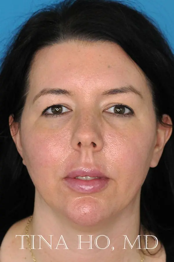 Patient's face showing results after a Philadelphia cheek augmentation and chin augmentation procedure, and dermal filler treatment.
