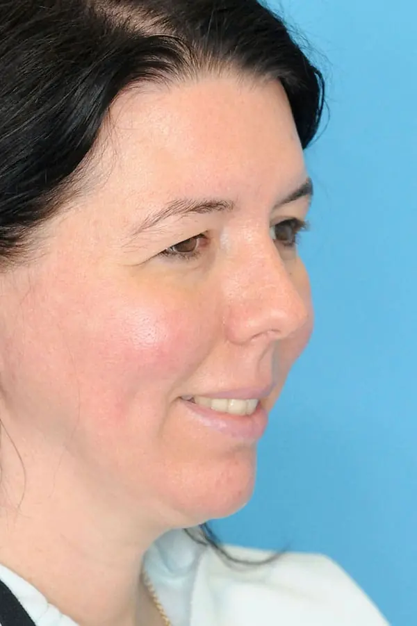 Patient's face showing results before a Philadelphia cheek augmentation and chin augmentation procedure, and dermal filler treatment.