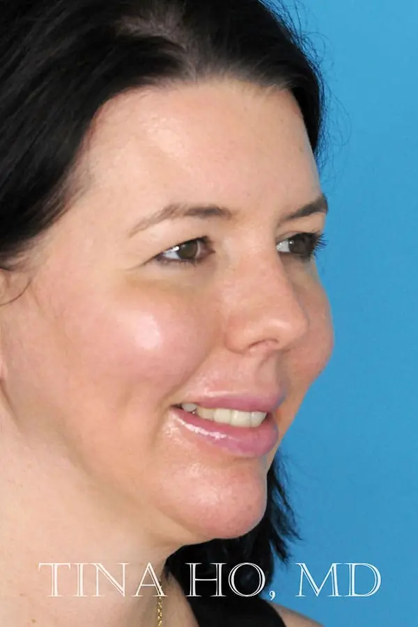 Patient's face showing results after a Philadelphia cheek augmentation and chin augmentation procedure, and dermal filler treatment.