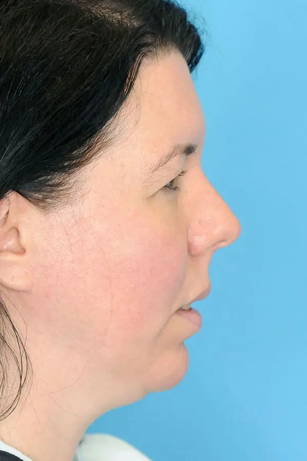 Patient's face showing results before a Philadelphia cheek augmentation and chin augmentation procedure, and dermal filler treatment.