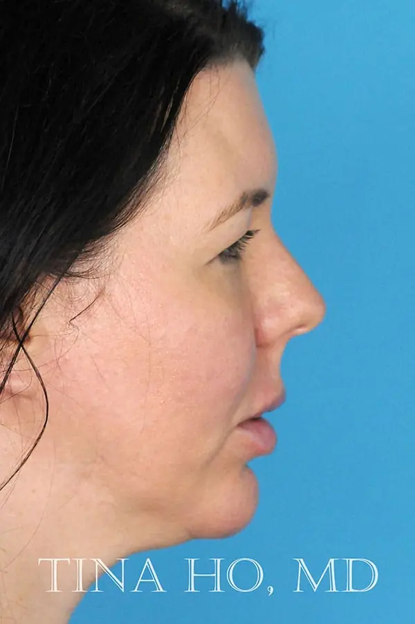 Patient's face showing results after a Philadelphia cheek augmentation and chin augmentation procedure, and dermal filler treatment.