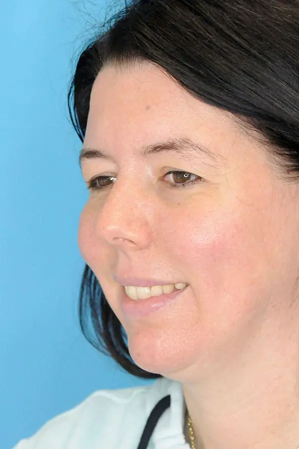 Patient's face showing before after a Philadelphia cheek augmentation, chin augmentation and dermal filler treatment