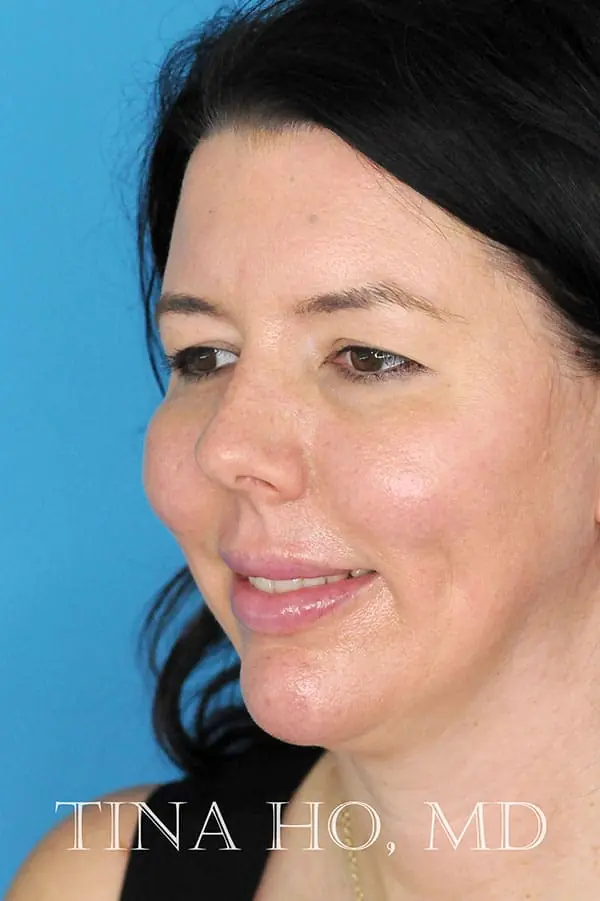 Patient's face showing results after a Philadelphia cheek augmentation, chin augmentation and dermal filler treatment