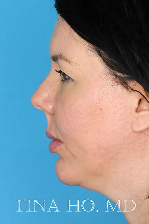 Patient's face showing results after a Philadelphia cheek augmentation, chin augmentation, and dermal filler treatment