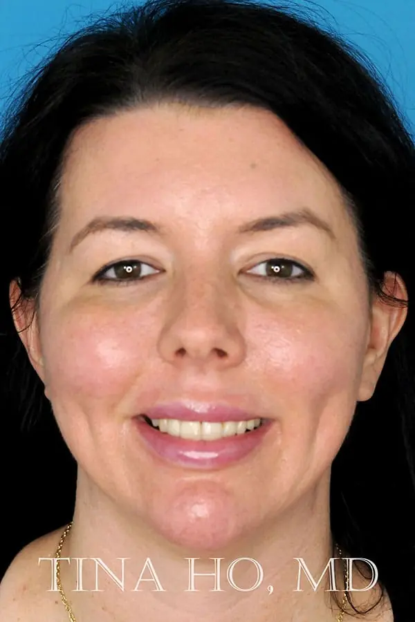 Patient's face showing results After a Philadelphia cheek augmentation, chin augmentation, and dermal filler treatment