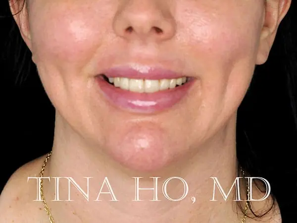 Female patient's lateral profile after successful chin augmentation procedure