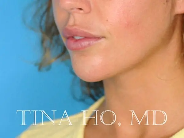 Female patient's lateral profile after chin augmentation procedure