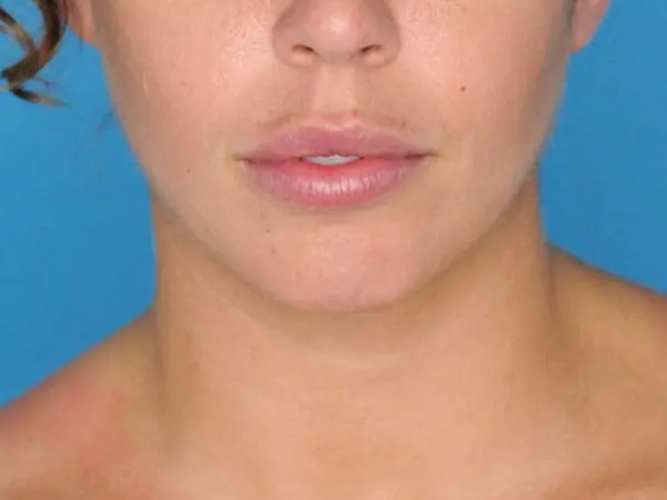 Female patient's frontal profile before chin augmentation procedure