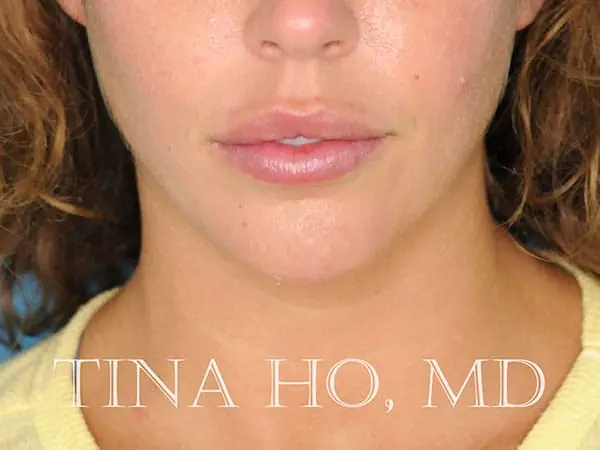 Female patient's frontal profile after chin augmentation procedure