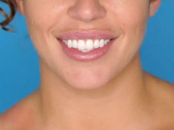 Female patient's frontal profile before chin augmentation procedure