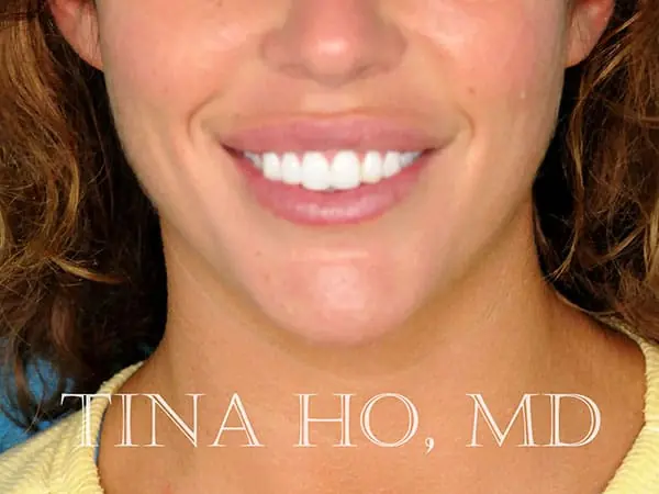 Female patient's frontal profile after chin augmentation procedure