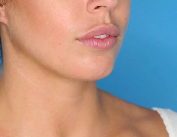 Female patient's lateral profile before chin augmentation procedure