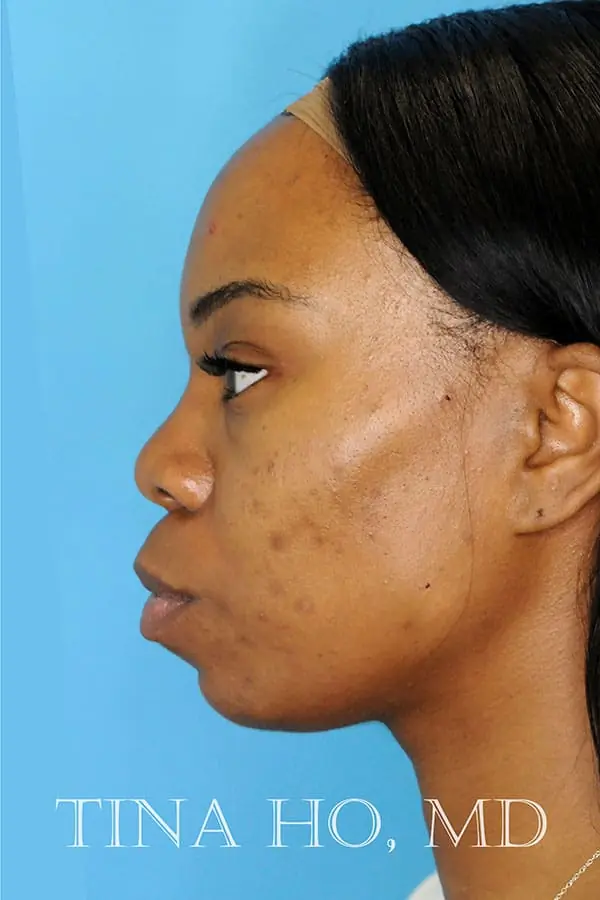 Patient's face showing results after a Philadelphia cheek augmentation procedure