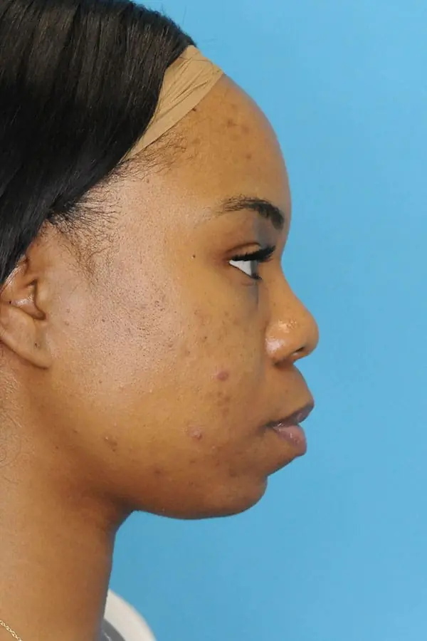 Patient's face showing results before a Philadelphia cheek augmentation procedure
