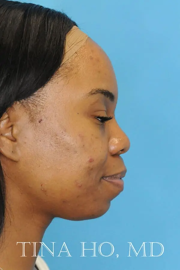 Patient's face showing results after a Philadelphia cheek augmentation procedure