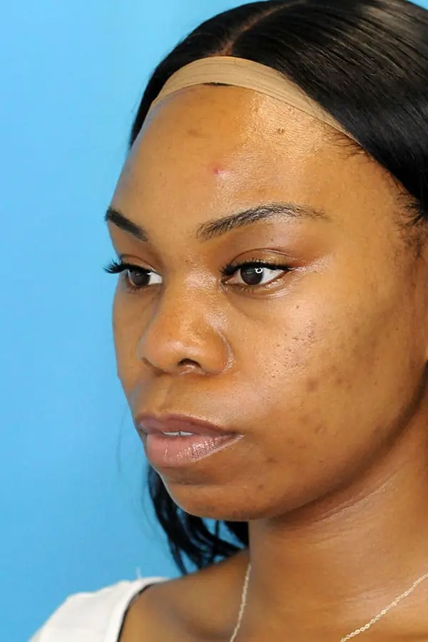 Patient's face showing results before a Philadelphia cheek augmentation procedure
