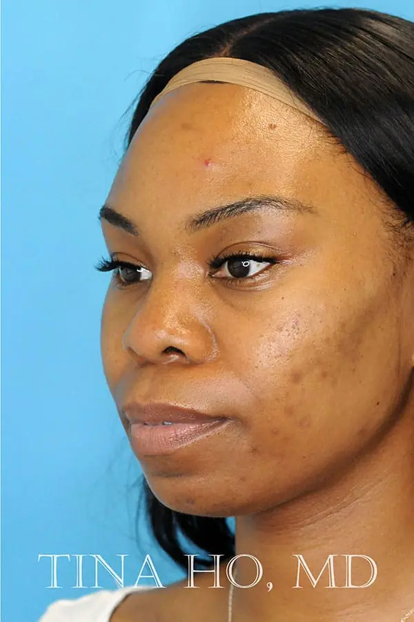 Patient's face showing results after a Philadelphia cheek augmentation procedure