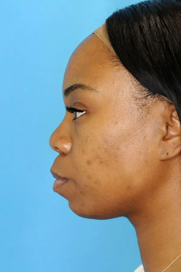 Patient's face showing results before a Philadelphia cheek augmentation procedure