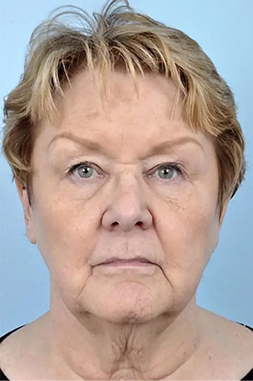 Patient's face showing results before a Philadelphia cheek augmentation procedure and dermal filler treatment for volume