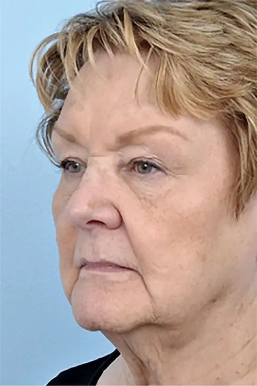 Patient's face showing results before a Philadelphia cheek augmentation procedure and dermal filler treatment for volume