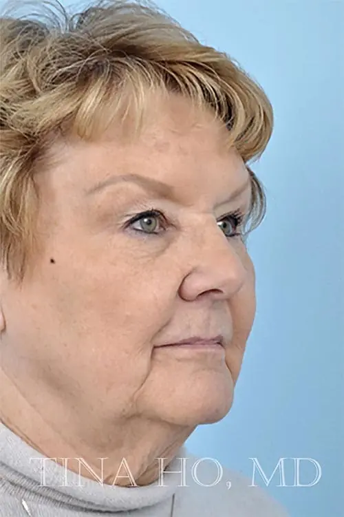 Patient's face showing results after a Philadelphia cheek augmentation procedure and dermal filler treatment for volume