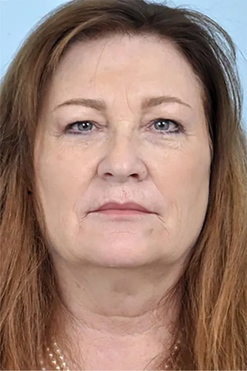 Patient's face showing results before a Philadelphia cheek augmentation and dermal filler treatment