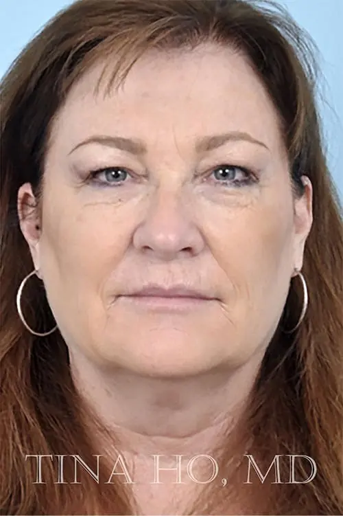 Patient's face showing results after a Philadelphia cheek augmentation and dermal filler treatment