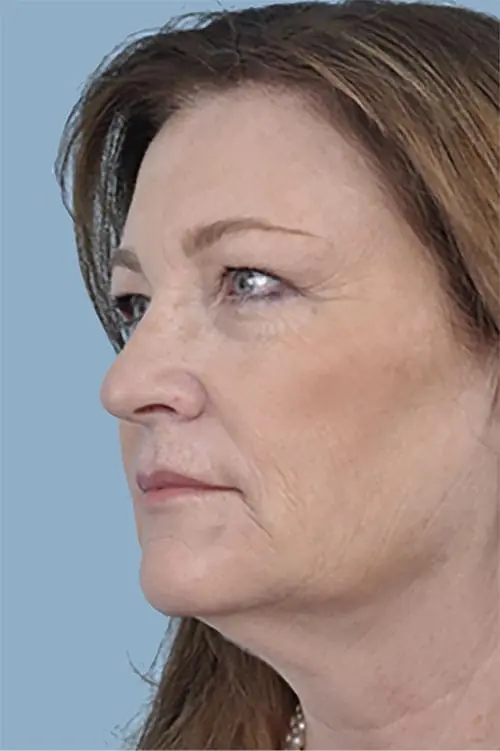 Patient's face showing results before a Philadelphia cheek augmentation and dermal filler treatment