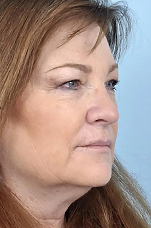 Patient's face showing results before a Philadelphia cheek augmentation and dermal filler treatment