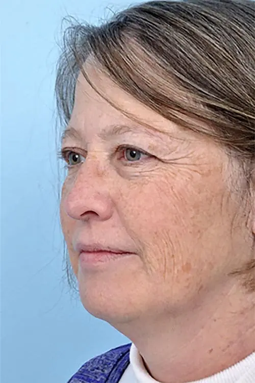 Patient's face showing results before a Philadelphia cheek augmentation procedure