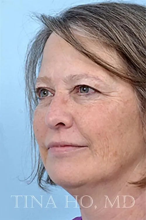 Patient's face showing results after a Philadelphia cheek augmentation procedure