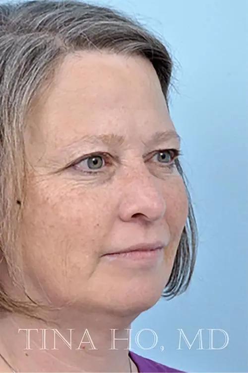 Patient's face showing results after a Philadelphia cheek augmentation procedure