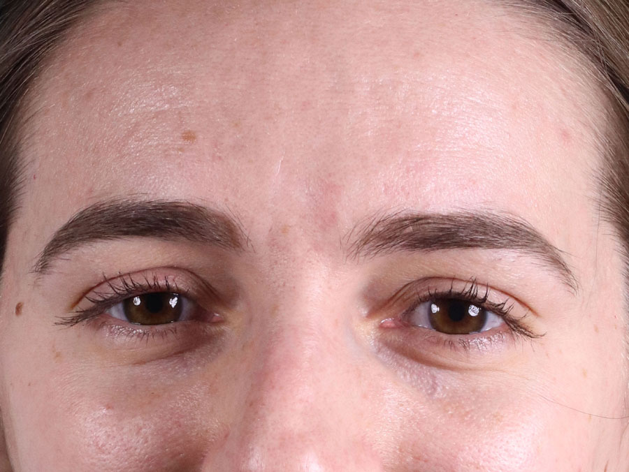Restylane-L Before & after