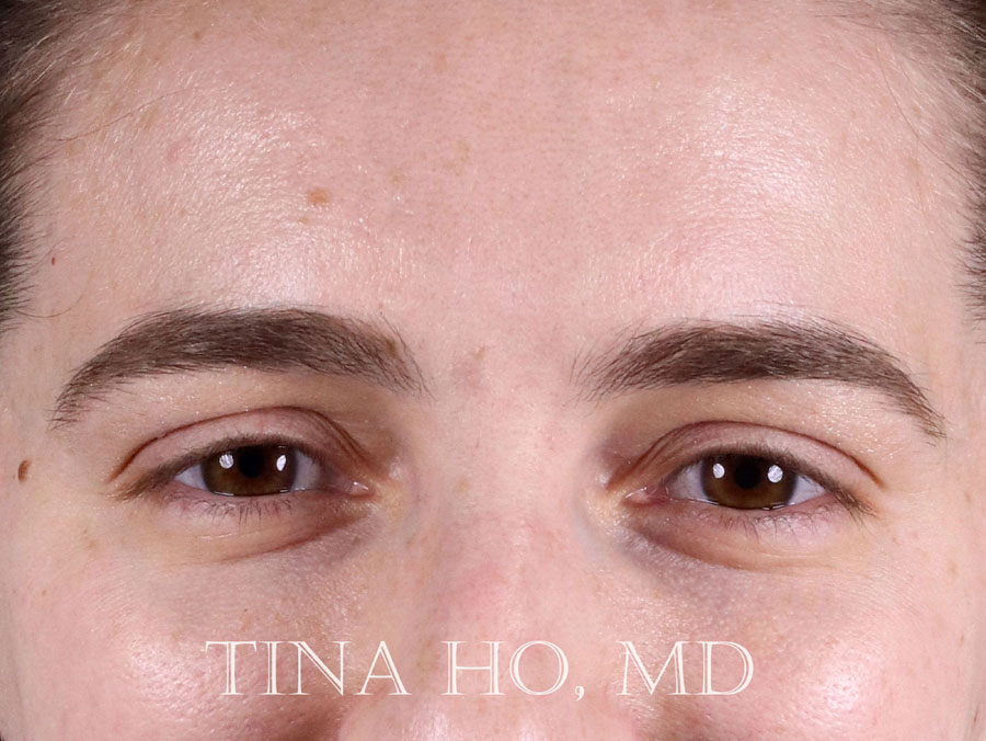 Restylane-L Before & after