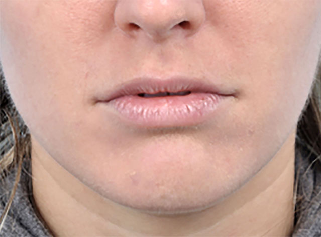 Lip Augmentation Before