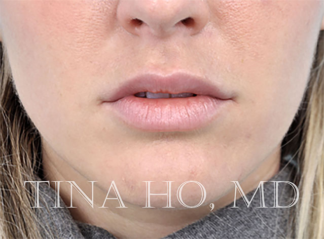 Lip Augmentation After