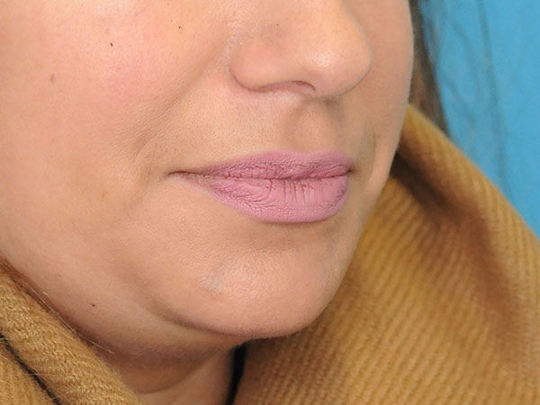 Lip Augmentation Before