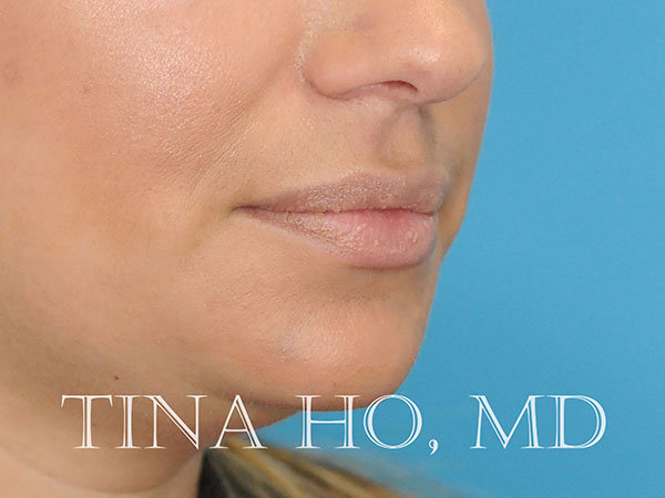 Lip Augmentation After