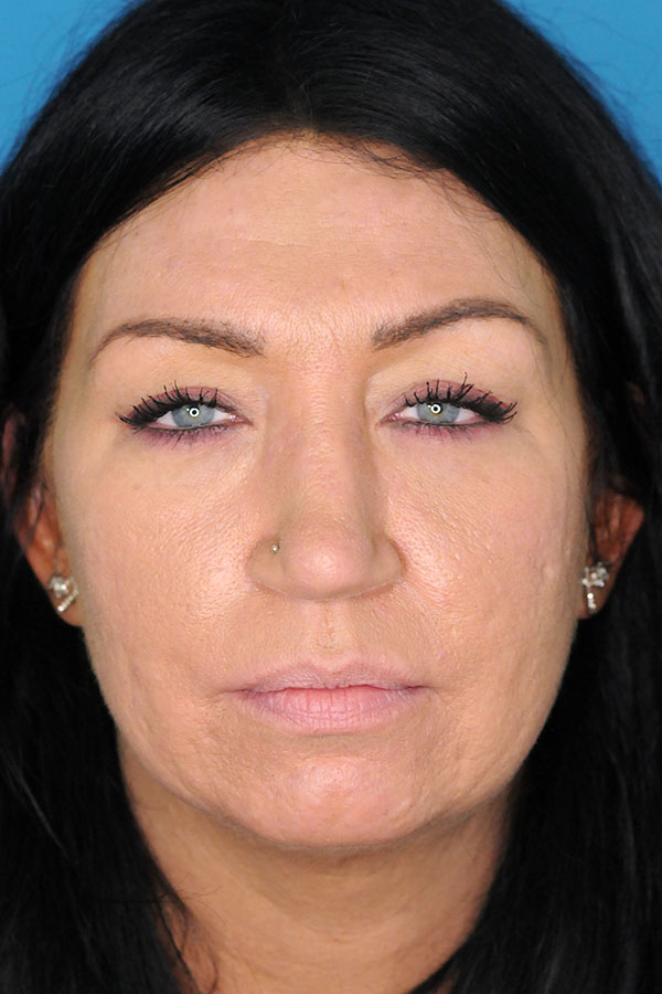 Lip Augmentation Before