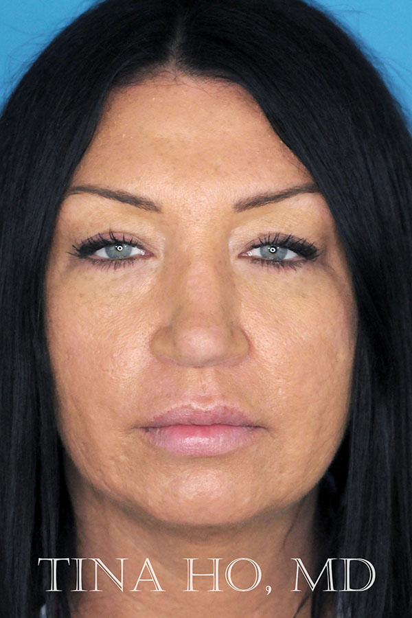 Lip Augmentation After